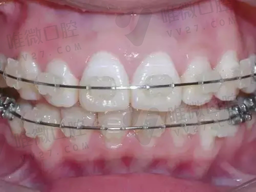 正规牙科和牙诊所做的假牙区别,注意事项！(图1)